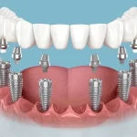 How Surgical Recovery Affects Your Musculoskeletal System and Rehabilitation Needs